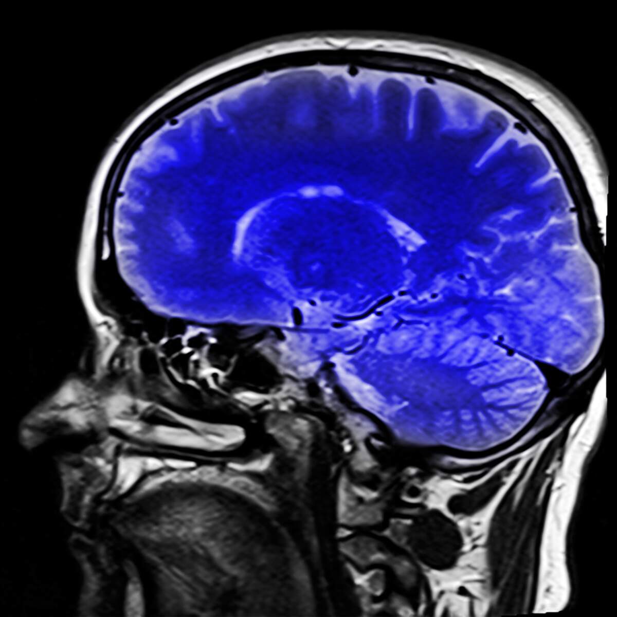 World Brain Tumor Day
