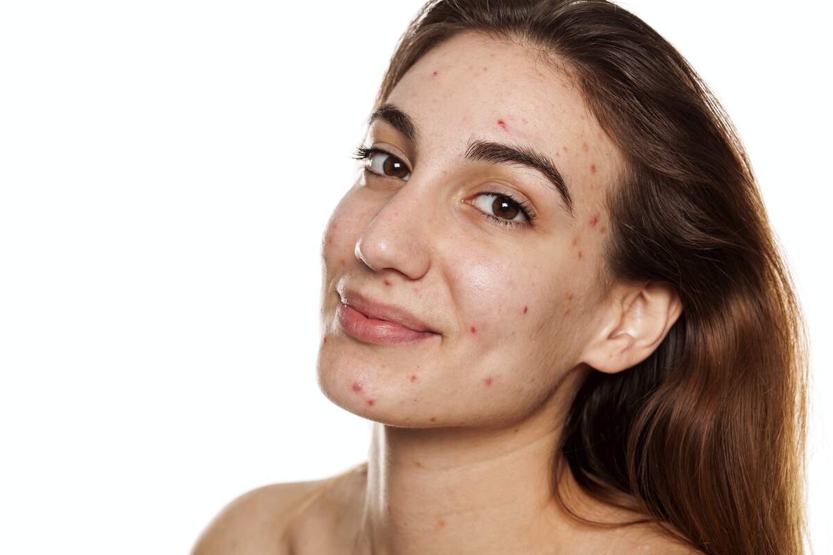 National Acne Positivity Day