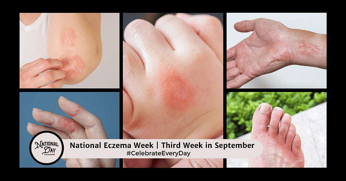 National Eczema Week